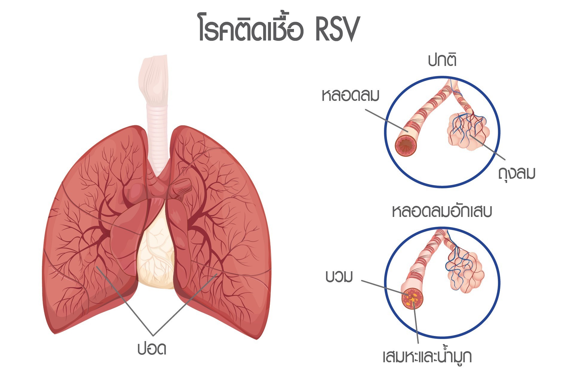 โรคติดเชื้อ RSV