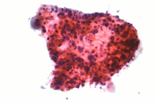 nsclc cancer มะเร็งปอดชนิดเซลล์ไม่เล็ก